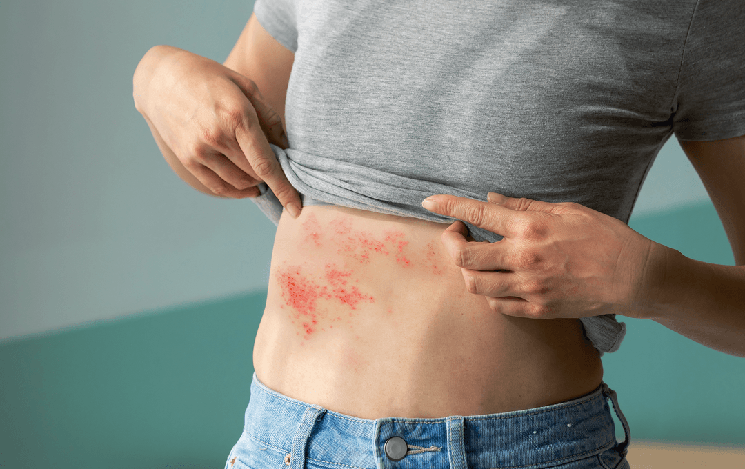 Herpes Zoster: o vírus que 94% das pessoas carregam, mas tem vacina!